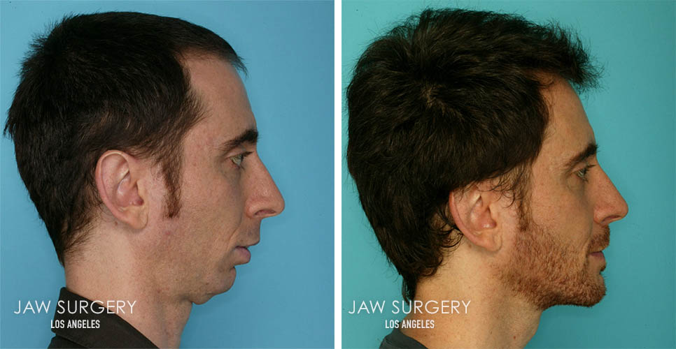 Before After Photos Los Angeles Ca Jaw Surgery La