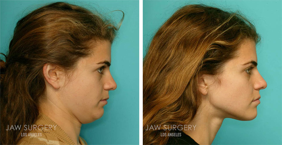 Before & After Photos Angeles, CA Jaw Surgery LA