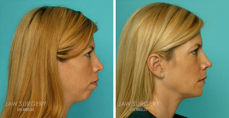 What Is Double Jaw Surgery? Your Top Questions Answered
