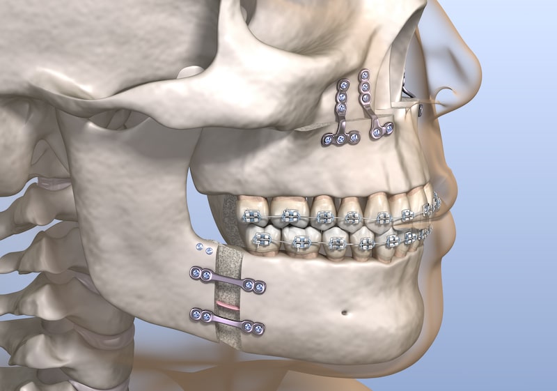 What Is Double Jaw Surgery Your Top Questions Answered Jaw Surgery LA