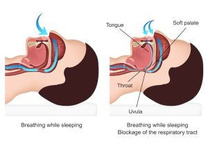 How Does Double Jaw Surgery Help Obstructive Sleep Apnea? | Jaw Surgery LA